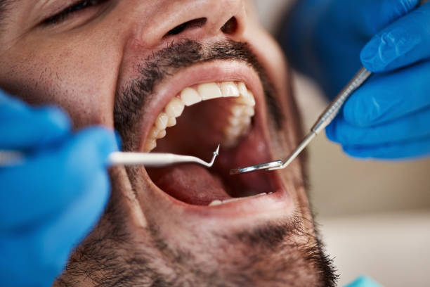 Best Chipped Tooth Repair Near Me  in Green Springs, OH